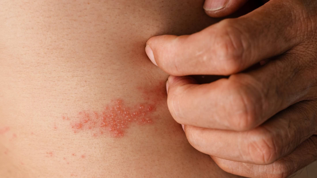 Symptoms of shingles on the skin, rash and blisters.